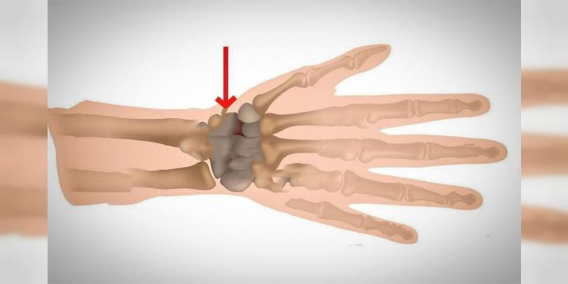 El Bileği Kırıkları