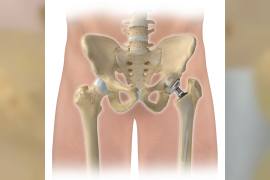 dogumsal-kalca-cikigi