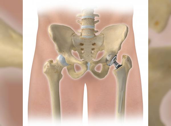 dogumsal-kalca-cikigi