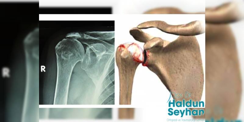 Akromioklavikuler (AC) Eklem Artrozu