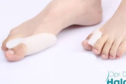 ameliyatsiz-halluks-valgus-tedavisi