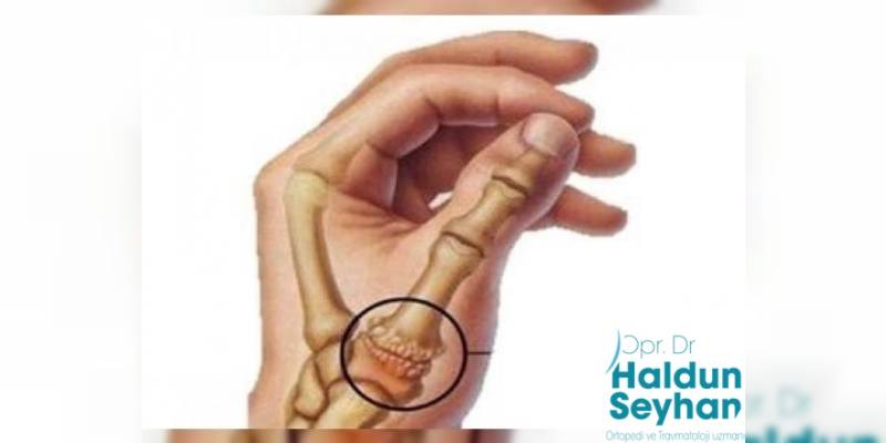 basparmak kok ekleminde kireclenme osteoartrit nedir op dr haldun seyhan