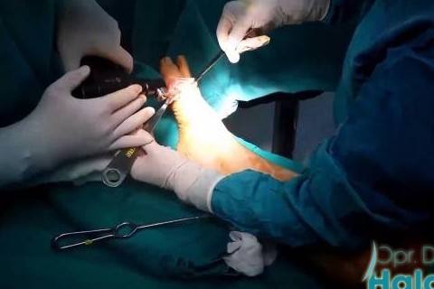 halluks-valgus-ameliyati
