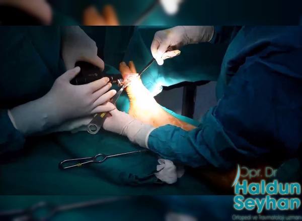 halluks-valgus-ameliyati