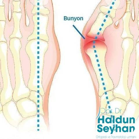 Halluks Valgus