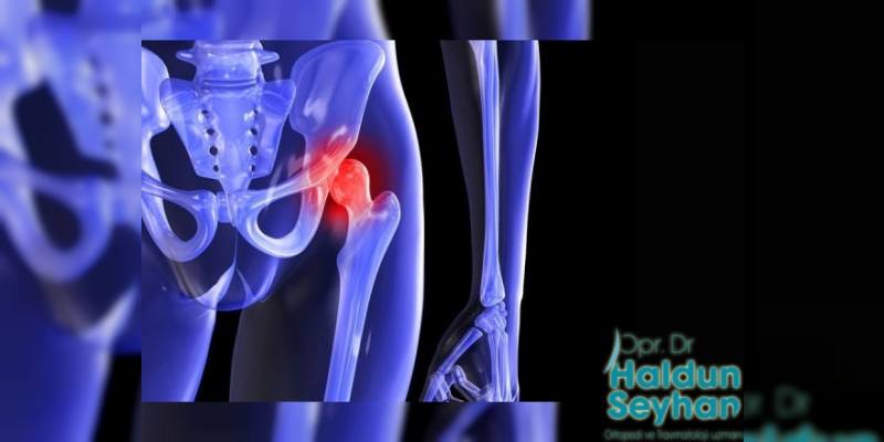 Kalça Kireçlenmesi ve Tedavi Yöntemleri Nelerdir?