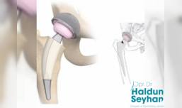 kalca-protezi-ameliyati