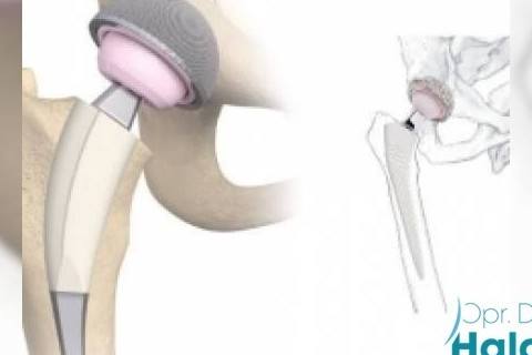 kalca-protezi-ameliyati