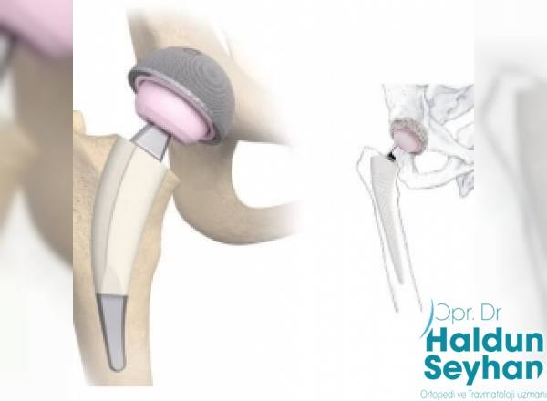 kalca-protezi-ameliyati