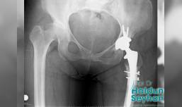 kalca-protezi-hangi-durumlarda-uygulanir