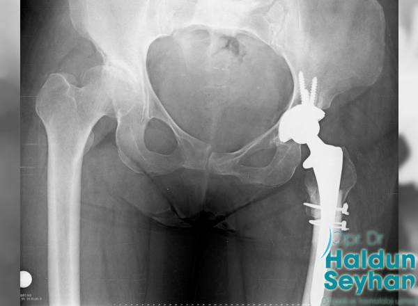 kalca-protezi-hangi-durumlarda-uygulanir