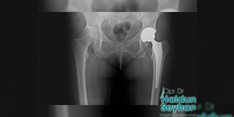 Kalça Protezi Nedir?