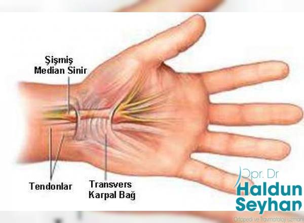 karpal-tunel-sendromu