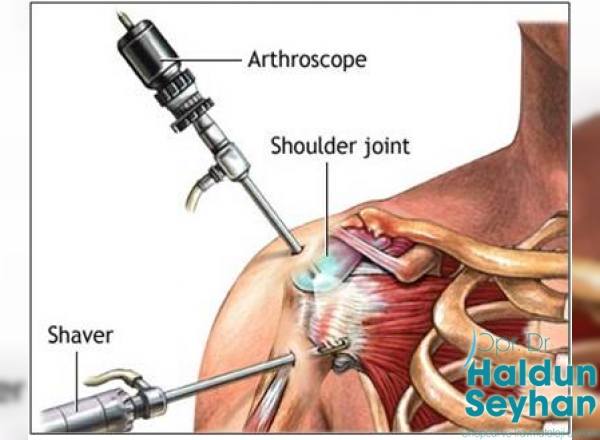 omuz-artroskopisi