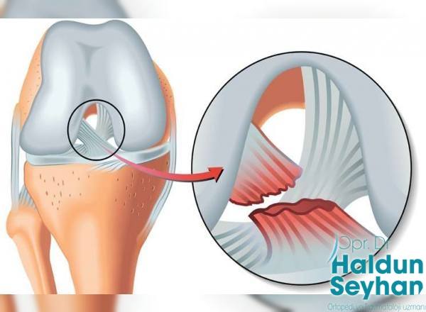 on-capraz-bag-yaralanmasi