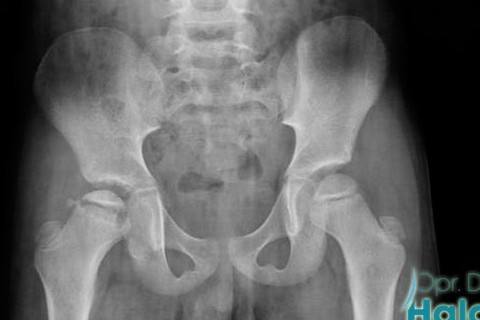 perthes-hastaligi