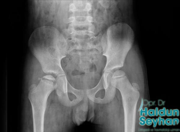 perthes-hastaligi
