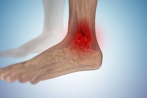 ayak-bilegi-kiriklari