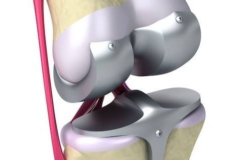 diz-protezi-ameliyati-sonrasi-iyilesme-sureci