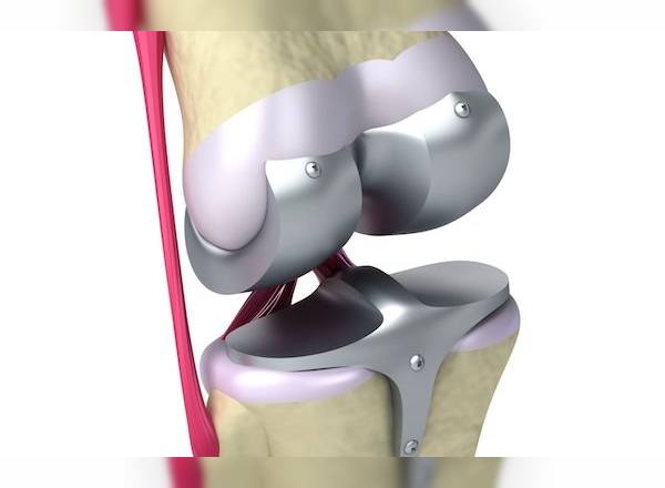 diz-protezi-ameliyati-sonrasi-iyilesme-sureci