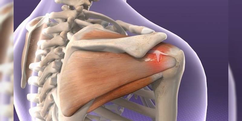 Rotator Manşet Yırtığı